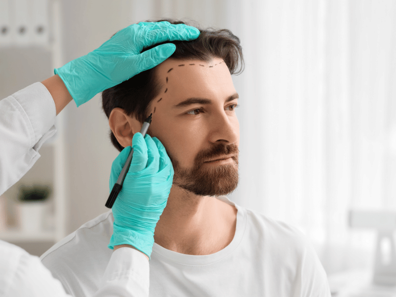 Hair Transplantation