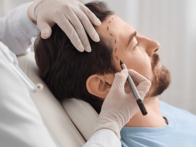 Hair Transplantation