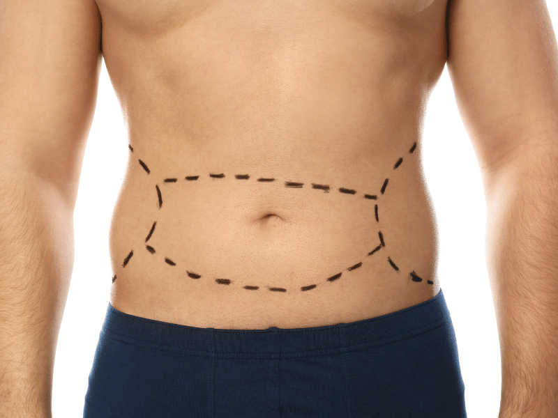 Tummy Tuck