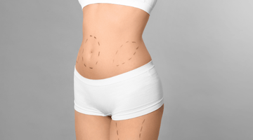 Tummy Tuck