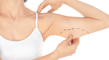 Arm Lift (Brachioplasty) What Is It?