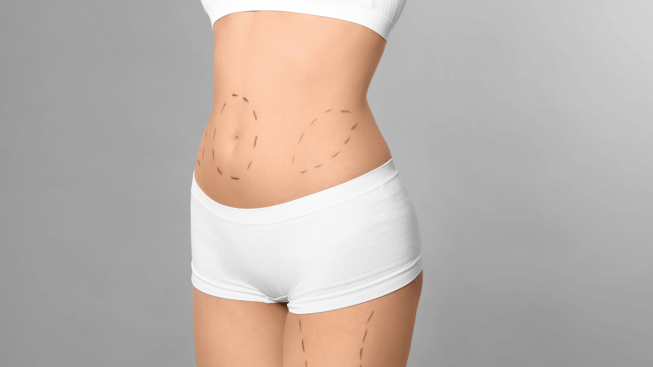 What Is Liposuction?