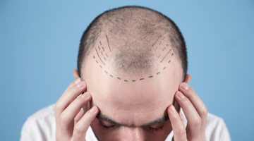 Hair Transplant – How Safe Is Hair Transplant Today?
